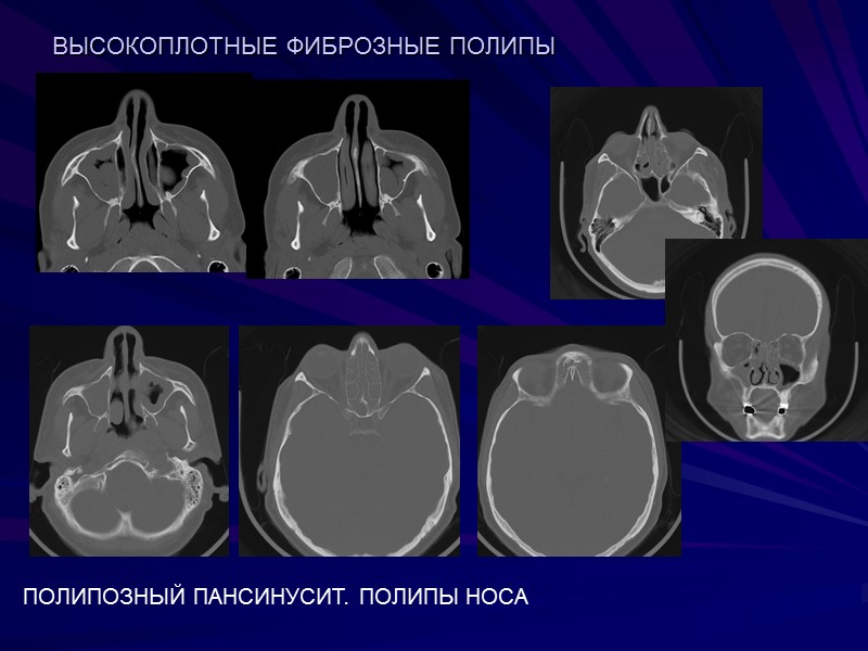 ВЫСОКОПЛОТНЫЕ ФИБРОЗНЫЕ ПОЛИПЫ  ПОЛИПОЗНЫЙ ПАНСИНУСИТ. ПОЛИПЫ НОСА
